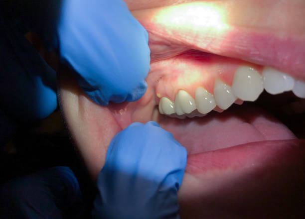 Best Emergency Tooth Extraction in Sullivan, IL