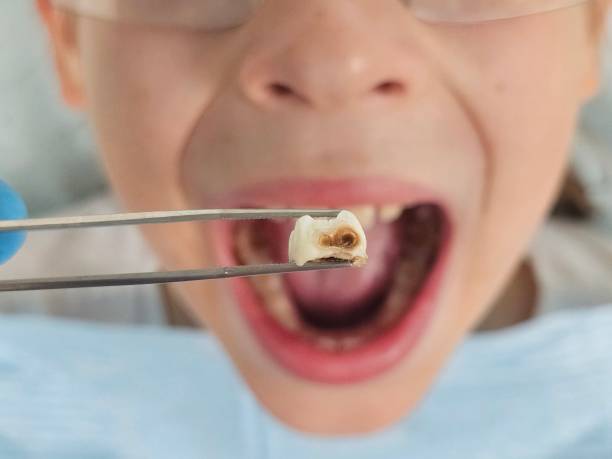 Best Emergency Root Canal Treatment in Sullivan, IL